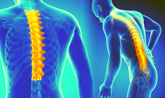 Spine osteochondrosis