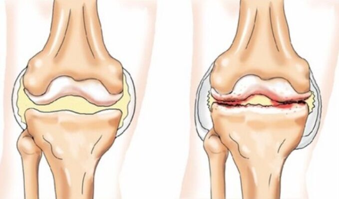 Arthritis and Arthrosis differences
