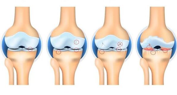 Osteortrosis stages