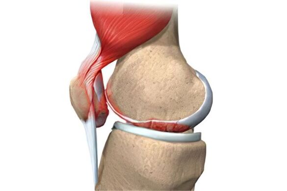 Arthrosis complications