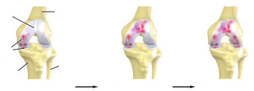 Arthrosis stages