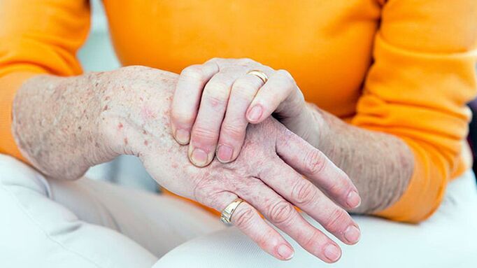 Brush arthrosis