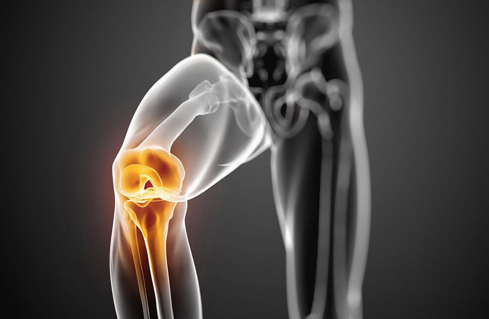 Knee articulation arthrosis