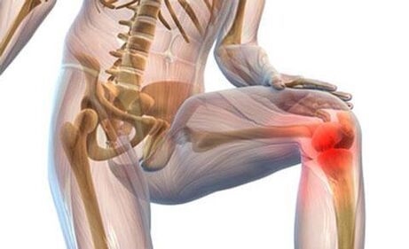 Knee articulation arthrosis