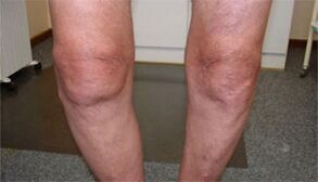 osteoarthritis symptoms