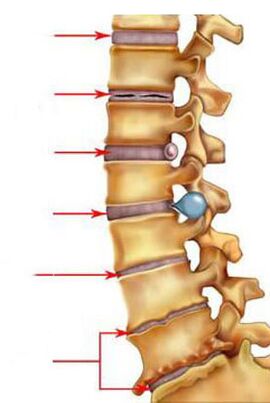 How osteochondrosis develops