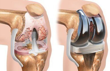Knee joint endoprostheses with gonarthrosis
