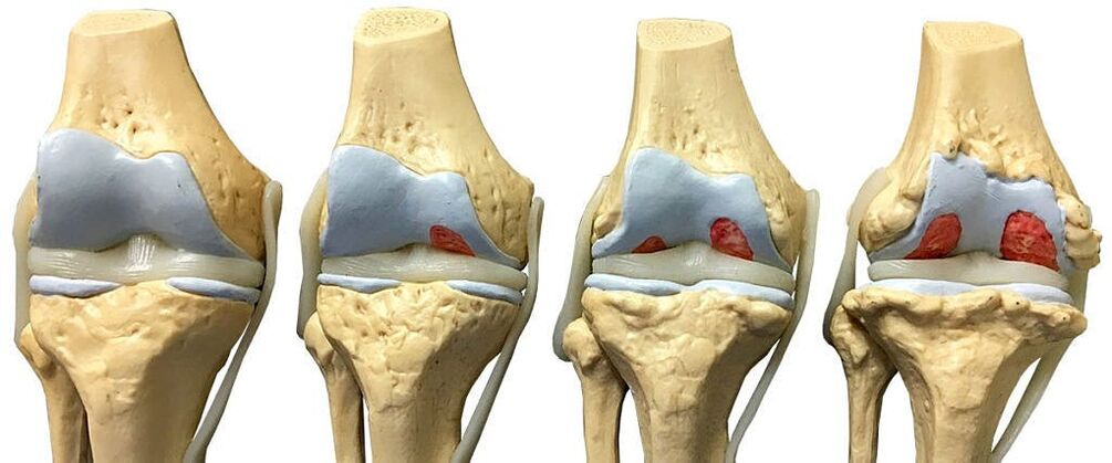 Osteoarthritis of the knee joint